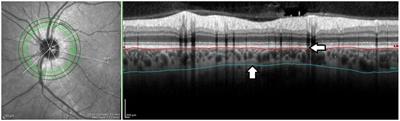 Peripapillary choroidal vascularity index and thickness in patients with systemic sclerosis